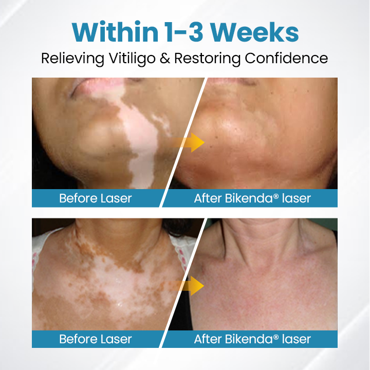 Nurbini® DermaBeam Vitiligo Therapy device