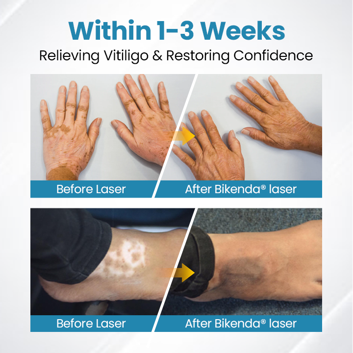 Nurbini® DermaBeam Vitiligo Therapy device