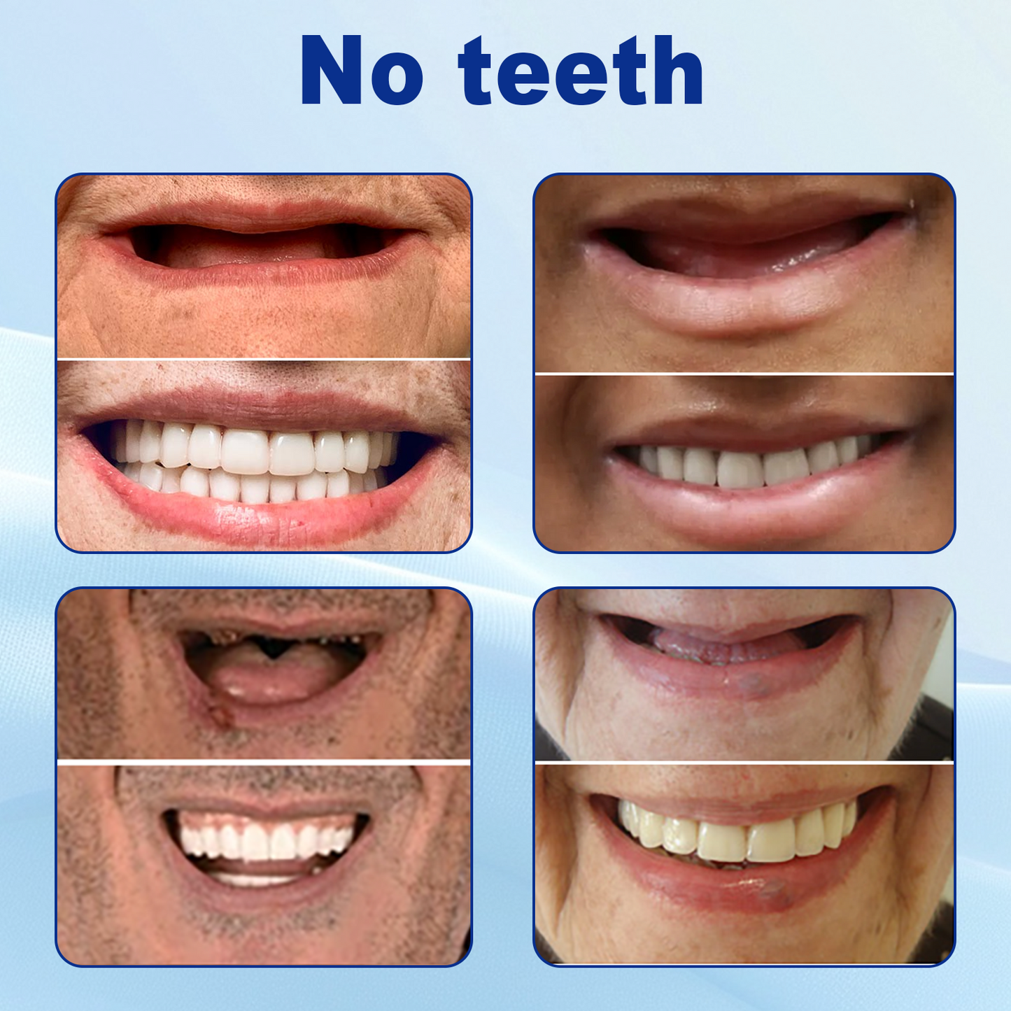 š¦·NurbiniĀ®Advanced Customized Full Denture Set >>ā
70% OFF