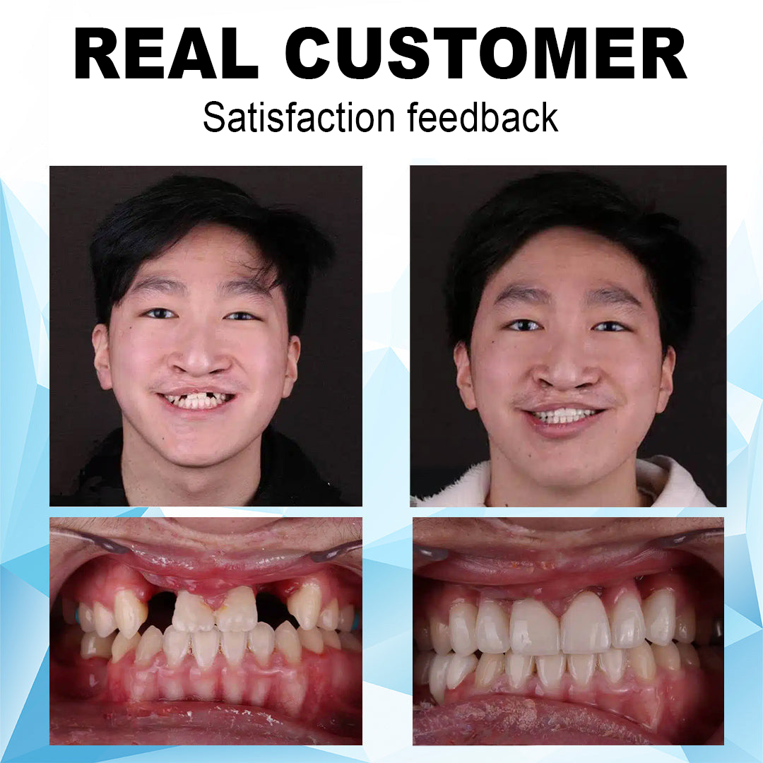 Dobshow ™ Silicone Reline Denture Set(⏰Limited time discount Last 30 minutes⏰)