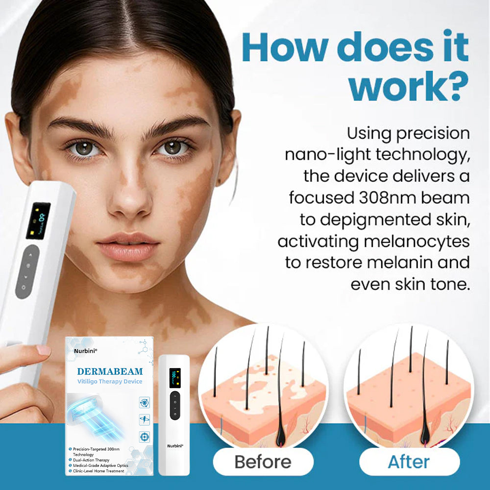 Nurbini® DermaBeam Vitiligo Therapy device