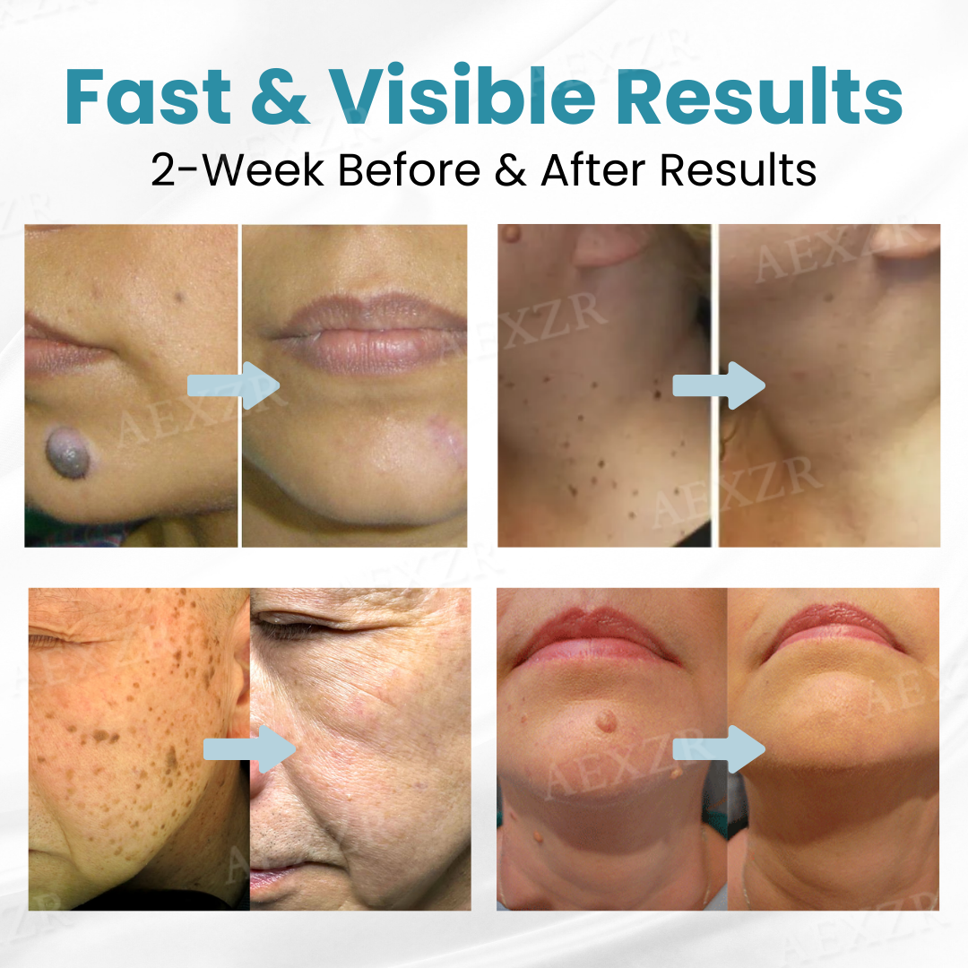 ✨Nurbini® Non-invasive Mole and Wart Removal Laser Pen✨