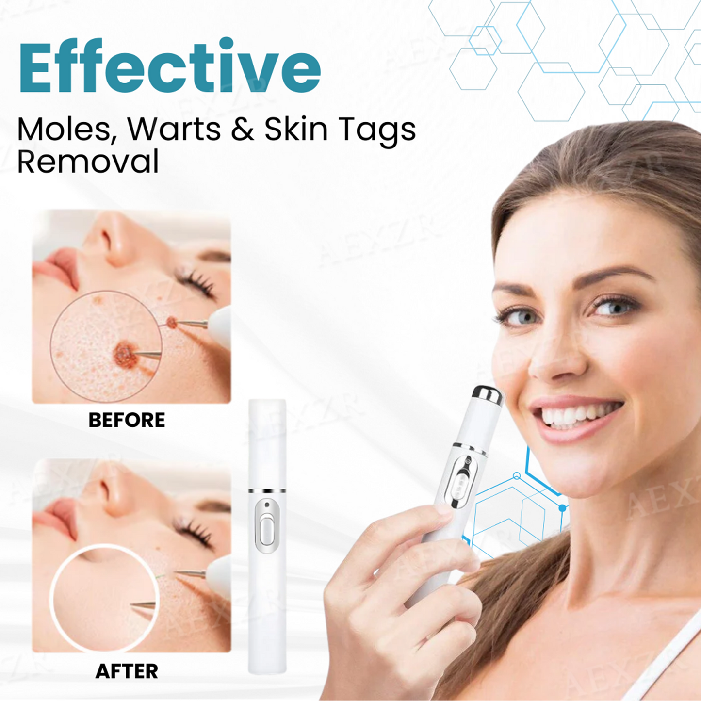 ✨Nurbini® Non-invasive Mole and Wart Removal Laser Pen✨