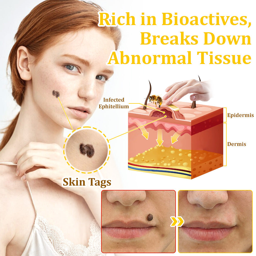 👨⚕️Dobshow™ Bee Venom Treatment Cream🐝: Treat Eczema, Psoriasis, Acne, Rosacea, Swelling, Varicose veins, Warts