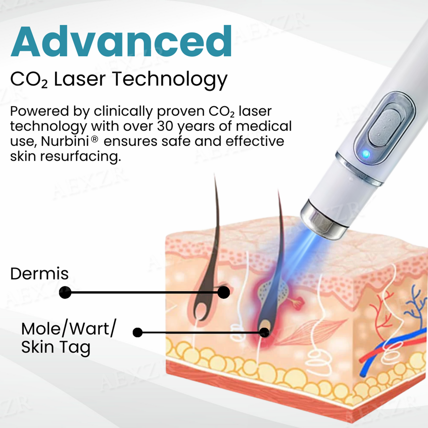 ✨Nurbini® Non-invasive Mole and Wart Removal Laser Pen✨