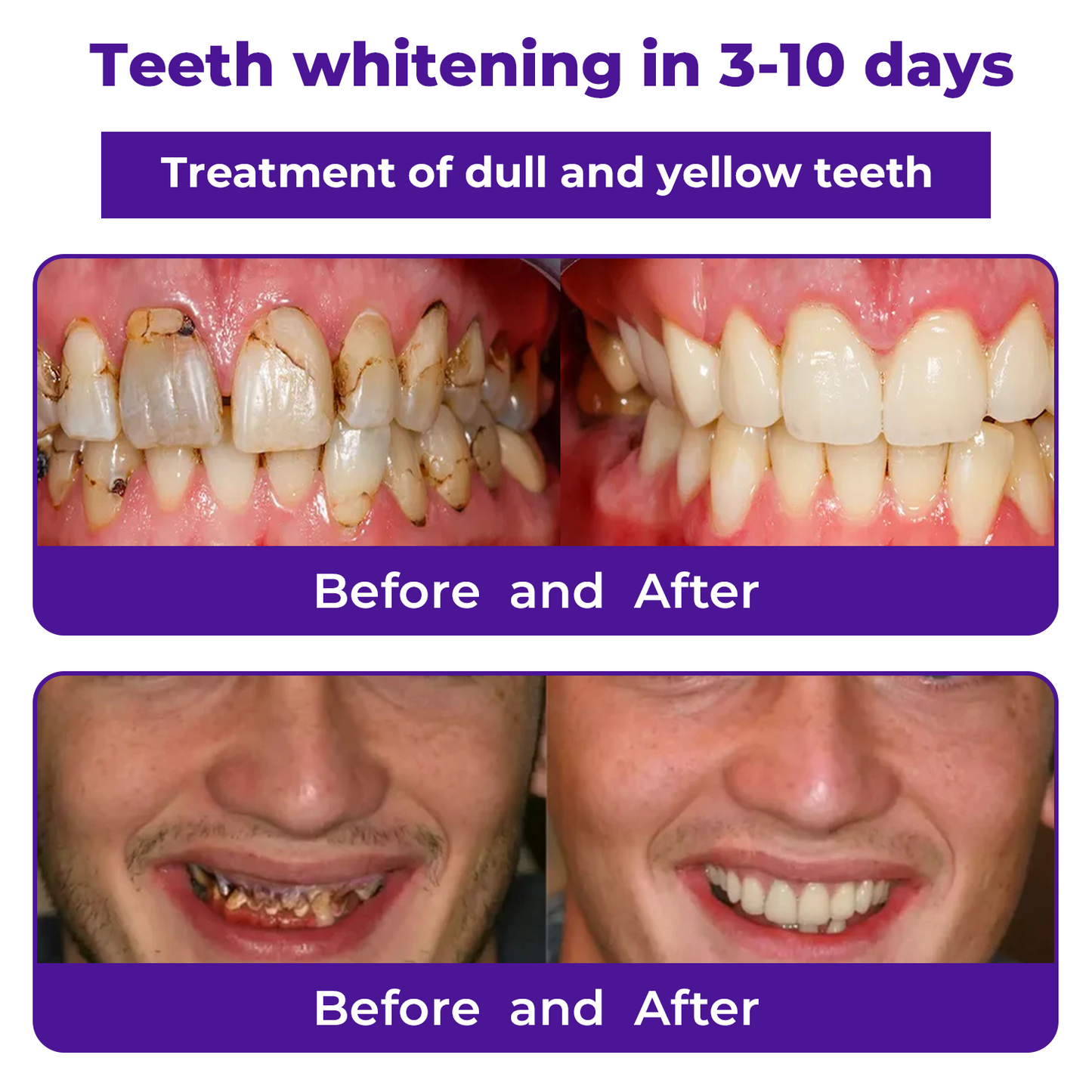 š¦·Dobshow⢠Dental Repair Mineral Powder >> š„Buy 1 Get 1 Freeš„