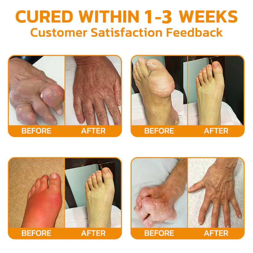 ✅Official Store: Dobshow™ Bee-Venom Pain-Relief Bone Healing Cream👨⚕️Orthopaedic Association(AOA) Approved (Reducing joint swelling, pain, stiffness, redness, warmth, soreness, and joint fatigue)