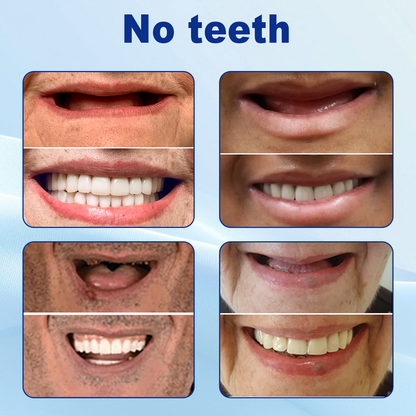 🦷Nurbini®Advanced Customized Full Denture Set >>✅70% OFF
