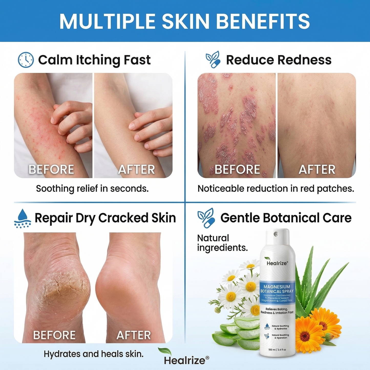 ✅ Official Store | Healrize® Magnesium Botanical Spray – Advanced Skin Recovery for Psoriasis & Eczema | Rapid Soothing, Steroid-Free