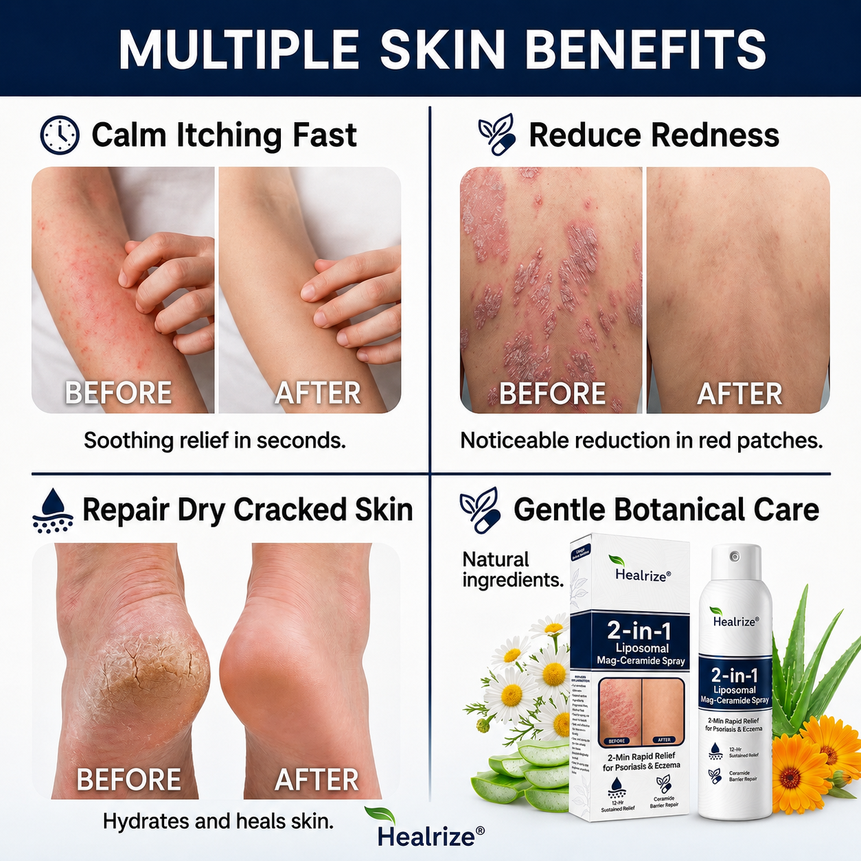 🔥56K+SOLD🔥Healrize® 2-in-1 Liposomal Mag-Ceramide Spray | 2-Min Rapid Relief for Psoriasis & Eczema (Full Body & Intimate Safe)