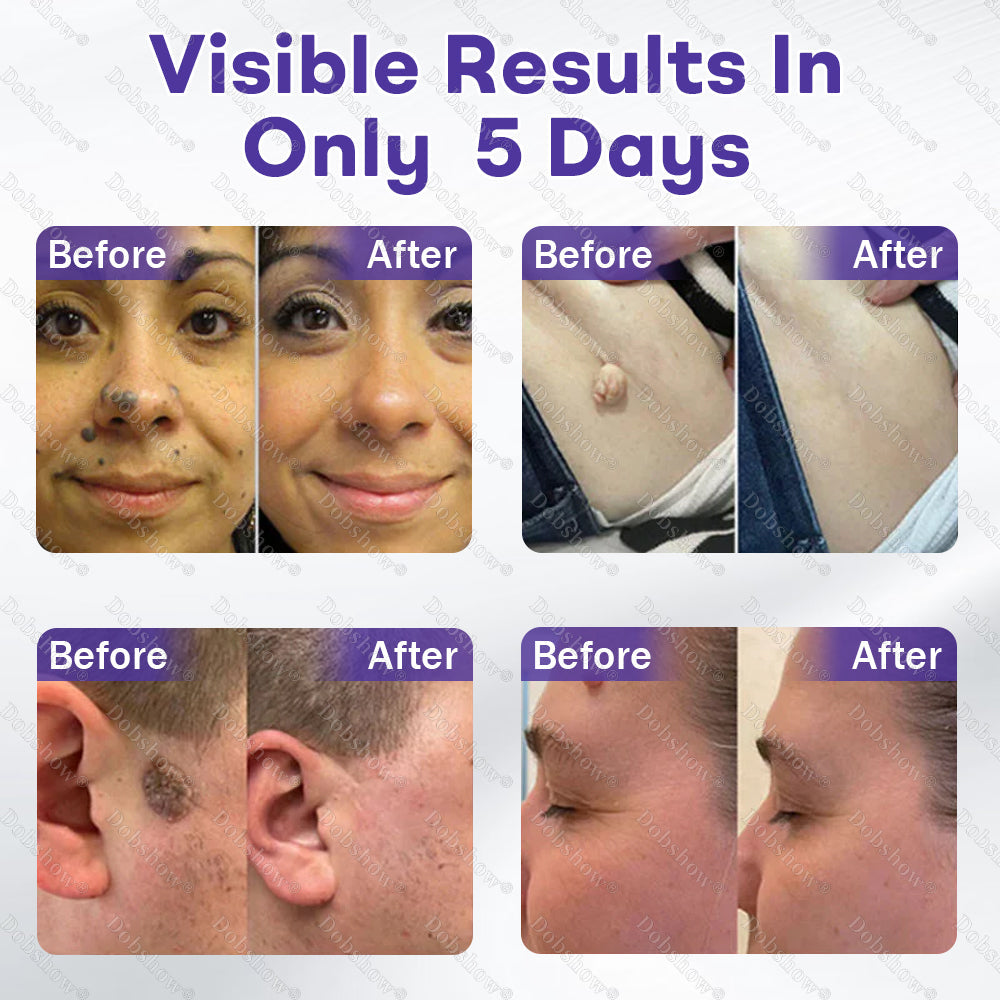 𝗗𝗼𝗯𝘀𝗵𝗼𝘄® 𝗪𝗮𝗿𝘁 𝗮𝗻𝗱 𝗺𝗼𝗹𝗲 𝗿𝗲𝗺𝗼𝘃𝗮𝗹 𝗺𝗶𝗰𝗿𝗼𝗻𝗲𝗲𝗱𝗹𝗲 𝗽𝗮𝘁𝗰𝗵