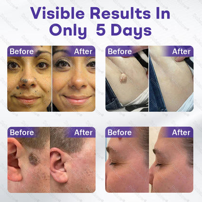 𝗗𝗼𝗯𝘀𝗵𝗼𝘄® 𝗪𝗮𝗿𝘁 𝗮𝗻𝗱 𝗺𝗼𝗹𝗲 𝗿𝗲𝗺𝗼𝘃𝗮𝗹 𝗺𝗶𝗰𝗿𝗼𝗻𝗲𝗲𝗱𝗹𝗲 𝗽𝗮𝘁𝗰𝗵