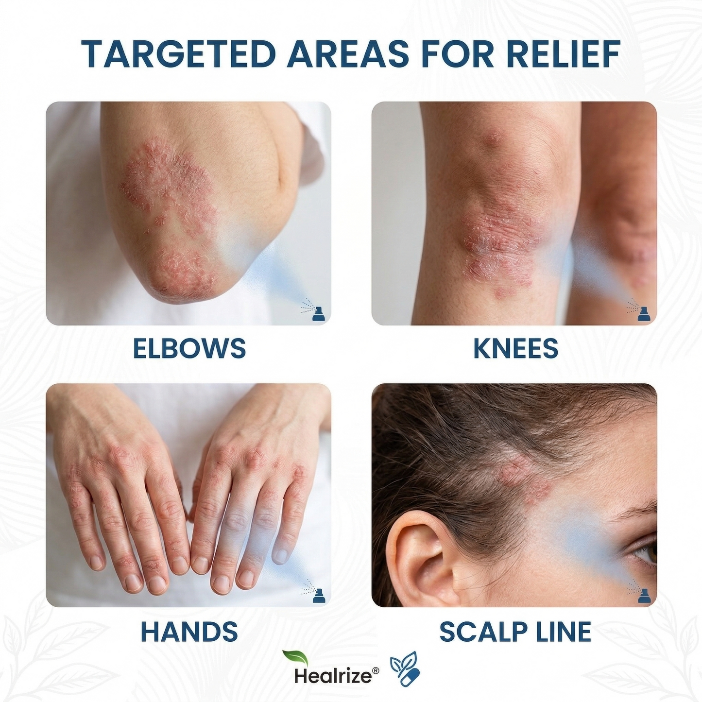 ✅ Official Store | Healrize® Magnesium Botanical Spray – Advanced Skin Recovery for Psoriasis & Eczema | Rapid Soothing, Steroid-Free
