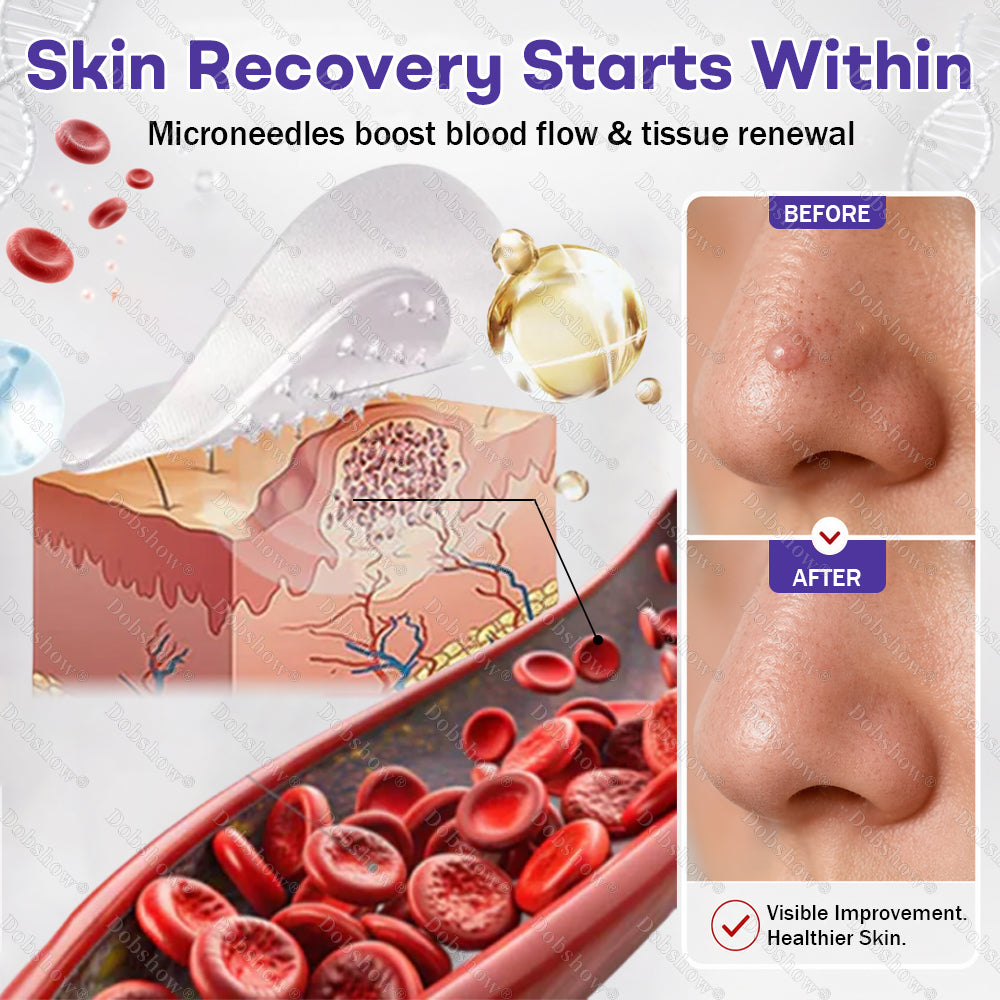 𝗗𝗼𝗯𝘀𝗵𝗼𝘄® 𝗪𝗮𝗿𝘁 𝗮𝗻𝗱 𝗺𝗼𝗹𝗲 𝗿𝗲𝗺𝗼𝘃𝗮𝗹 𝗺𝗶𝗰𝗿𝗼𝗻𝗲𝗲𝗱𝗹𝗲 𝗽𝗮𝘁𝗰𝗵