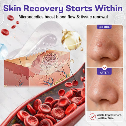 𝗗𝗼𝗯𝘀𝗵𝗼𝘄® 𝗪𝗮𝗿𝘁 𝗮𝗻𝗱 𝗺𝗼𝗹𝗲 𝗿𝗲𝗺𝗼𝘃𝗮𝗹 𝗺𝗶𝗰𝗿𝗼𝗻𝗲𝗲𝗱𝗹𝗲 𝗽𝗮𝘁𝗰𝗵