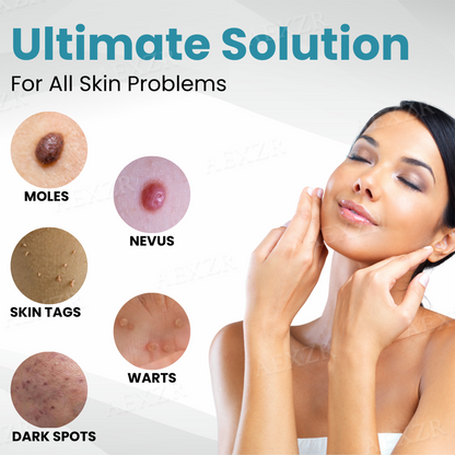 ✨Nurbini® Non-invasive Mole and Wart Removal Laser Pen✨